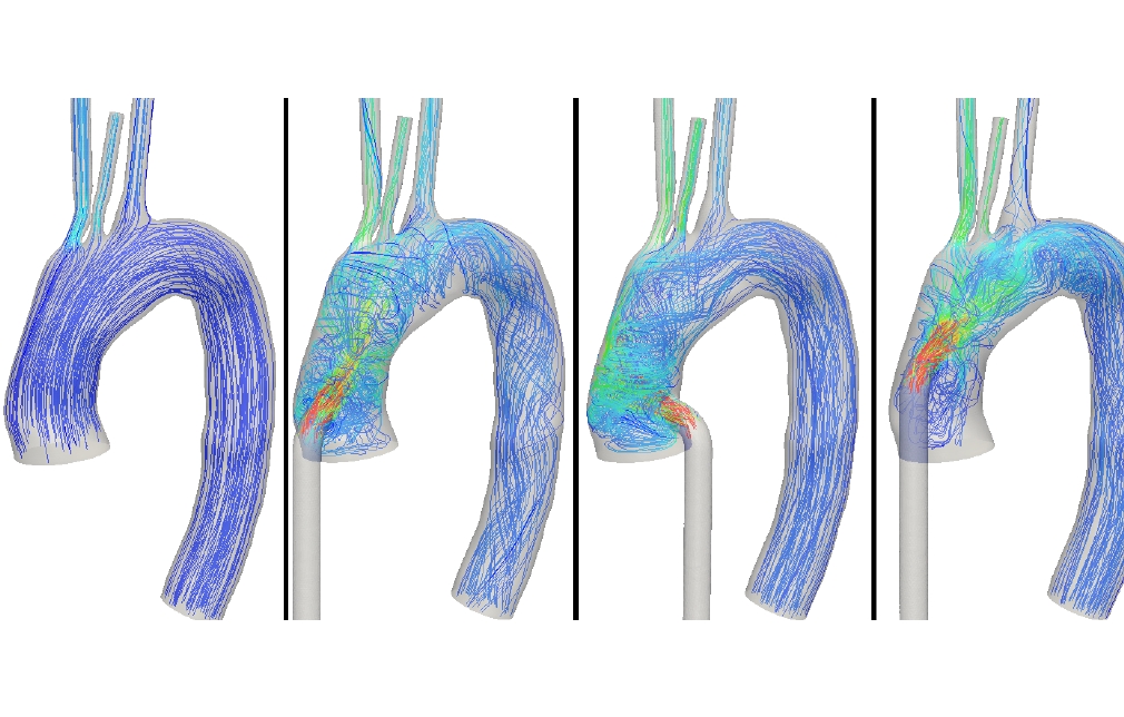 LVAD